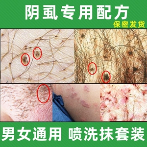 治疗阴虱病的药阴虱子药去除虱虫虱卵一扫光百部酊灭阴毛狮子喷剂
