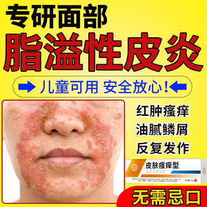 脂溢性皮炎面部脸护肤品鼻子两侧发红脱皮鼻翼两边泛红干燥起皮XQ