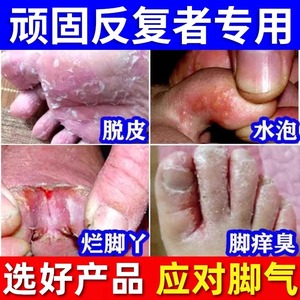 脚气烂脚丫药脱皮糜烂脚趾缝烂痒水泡型杀菌止痒真菌感染日本喷剂