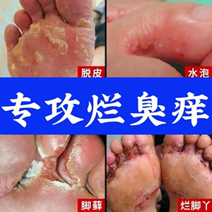 脚气脚臭痒脱皮烂脚丫止痒真菌感染官方正品zj岳家老铺大药房旗舰店
