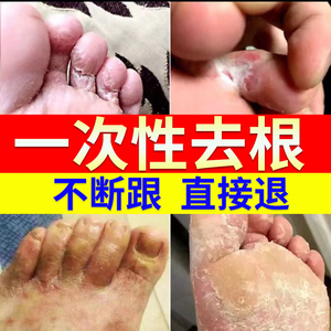 治香港脚气药根治止痒去根神器脱皮杀菌脚痒真菌感染水泡型烂脚丫