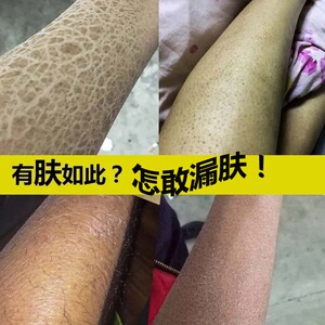 维a酸腿上毛孔堵塞通软膏倍润u清正品祛黑色素角质去鸡皮肤身体乳