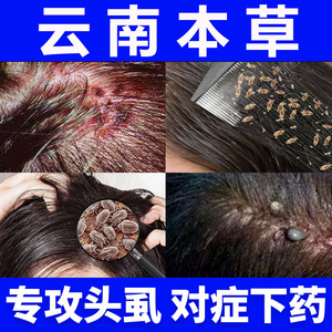 云南本草虱子药儿童小女孩头发头虱一扫光百部酊灭阴虱去虱卵神器