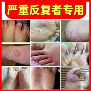 脚气药根治止痒脱皮杀菌除水泡型真菌感染抑菌膏治疗脚气去根神器