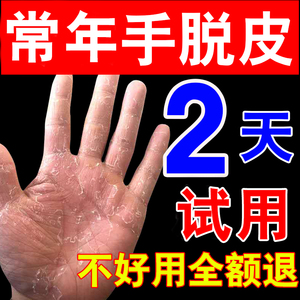 手脱皮的药膏真菌感染脚干裂蜕皮护手霜手裂防干裂季节性涂抹干燥