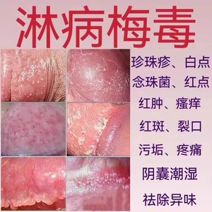 生殖男器疱疹断根克星带状疱疹防复发私处护理治性病梅毒hsv药膏