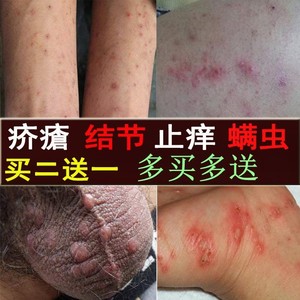 疥疮结节顽疥清百灭宁疥疥舒阴囊软膏硫磺结节虱疥一扫光疥疮