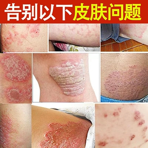 虎狼百草止痒膏牛皮廯藓皮肤瘙痒外用药手足藓体股藓祛癣抑菌乳膏