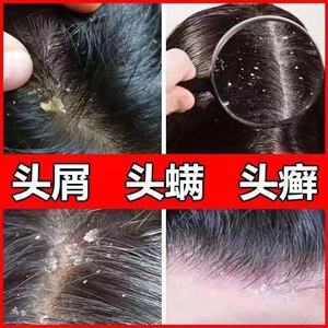 头皮藓头皮清理去大块头屑的药膏去屑除螨虫治头癣止痒洗发水精华