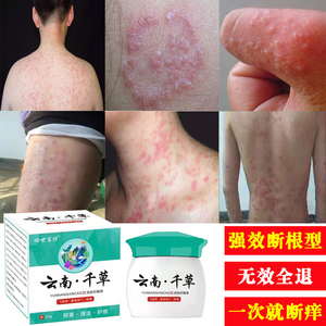 癣药膏正品杀菌外用软膏苗药湿毒清肛周肛门湿疹止痒去根顽固慢性