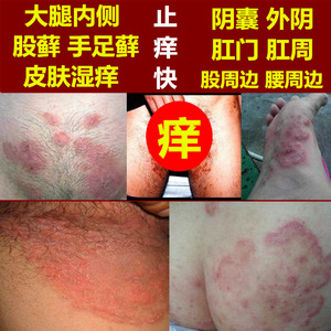 男女大腿内侧股藓体手廯外用皮肤痒特效阴囊肛门周外阴止痒膏成人
