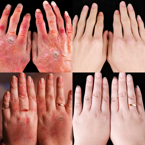 冻疮膏治根消肿防冻止痒冻伤冻手部脸部耳朵红肿防裂霜正品神器