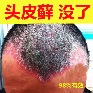 李氏百草膏去头皮癣药膏专用真菌感染皮肤牛皮癣银屑癣外用头部藓