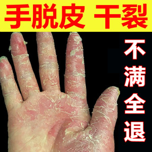 李氏手脱皮开裂治疗手裂的药膏真菌感染鹅掌风手蜕皮脚干裂手足藓