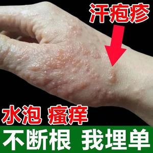 李一氏汗疱疹汗孢疹手上起小水泡汗状疱疹专用软膏药膏汗泡疱疹