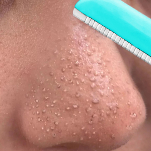 乳糖酸精华原液 修复粗大毛孔 去黑头粉刺闭口 男女通用买二送一