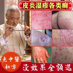 专用湿疹止痒治疗手藓癣膏真菌感染特效神经性皮炎皮肤成人外用膏