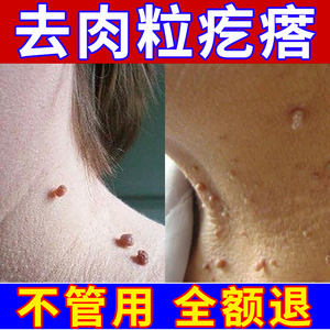 祛瘊子痦子去除膏去除神器猴子皮赘药疙瘩肉瘤凸痣脖子上长小肉粒