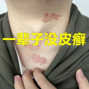 牛皮癣藓廯银屑皮肤瘙痒湿疹止痒抑菌祛根股体癣专用癣祛药膏