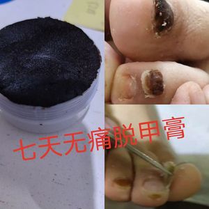 软甲膏去除灰脚指甲灰甲液软化灰甲膏无痛增厚脱甲膏脱甲精油护理