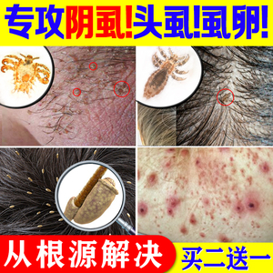 虱子药儿童小女孩头发百部酊虱立净除阴虱一扫光正品男士去除虱卵