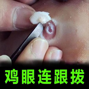修正鸡眼膏专用除脚趾疣瘊子去除手部足部脚底肉刺根同仁堂鸡眼贴