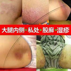 藓药膏真菌股廯体藓大腿内侧瘙痒真菌感染股体藓男士大腿私处湿疹
