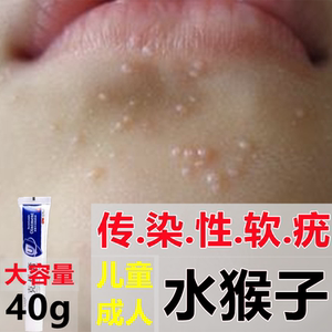 传染性软疣儿童病毒性软疣药膏治療水猴子的药去除宝宝大人克疣膏