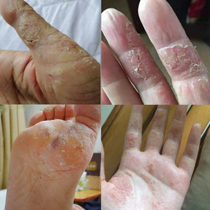 手癣膏手足癣脚真菌感染脱皮干裂治疗湿疹皮肤病专用止痒药膏去根