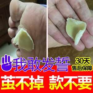 去除老茧膏贴特效脚茧滴液关节茧脚垫老茧净祛死皮手茧脚茧去茧净