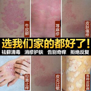 癣膏