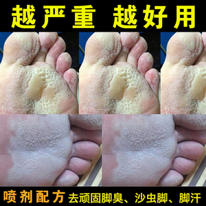 去除脚臭臭脚粉止汗剂除臭泡脚汗根汗脚出汗喷剂沙虫脚药神器男女