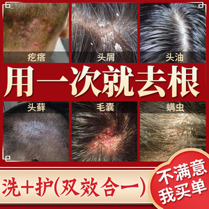 头皮癣药膏