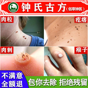 去猴子肉粒疙瘩治鱼鳞痣修子瘊子药祛脚肉刺猴去除神器手足部正品