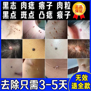 去痣点痣膏无痕正品药水脸部祛痣祛斑痦子取痣贴黑痣去除黑点神器