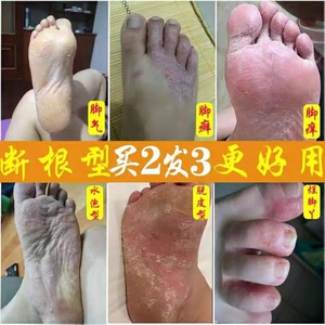 治疗脚气神器脚痒脱皮杀菌水泡型脚臭药膏止痒真菌感染烂脚丫去根