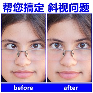 纠正斜眼对眼斗鸡眼睛矫正器治斜视弱视治斜视成人儿童训练眼镜罩