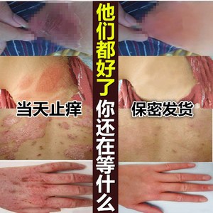 西多福韦软膏恩芙肤美抑菌软膏栢草本心堂抑菌乳膏贝婴因邦迪宁湿