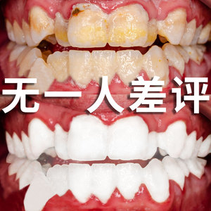 去牙菌斑祛除神器强力黄牙牙屎专用牙斑净牙齿美白速效牙渍克星
