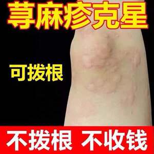 专用治疗急慢性荨麻疹过敏止痒断根去风团划痕皮肤瘙痒克星中药膏