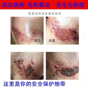 性病一扫光梅毒除喷剂治殖龟头炎病皮肤汗疱疹病外用龟头私处