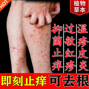 皮肤瘙痒止痒抑菌外用湿疹止痒去根顽固皮炎全身过敏红疹止痒药膏
