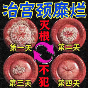 治疗宫颈糜烂的药妇科凝胶消糜栓重度阴道炎白带异味宫颈肥大用药