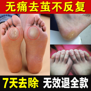 去除老茧脚茧鸡眼专用脚掌厚死皮膏软化剂祛手脚趾关节茧神器去根