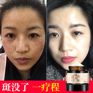 祛斑霜美白面部男女士淡化去除黑色素沉淀脸部色斑正品脸上学生