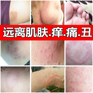 成人外用大腿内侧瘙痒肛门潮湿屁眼男女私处头皮止痒皮肤抑菌软膏