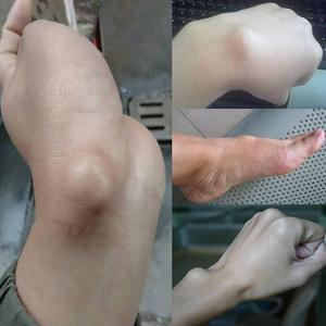 【消鼓包】腱鞘贴手指关节疼痛腱鞘焱膏健鞘舒筋贴大拇指手腕疼痛