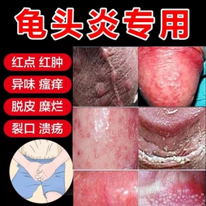 尿道焱尿路感染男女【小便刺痛】尿频尿急尿分叉尿黄尿骚尿口灼热