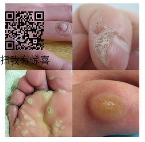 去脚刺猴子膏特效