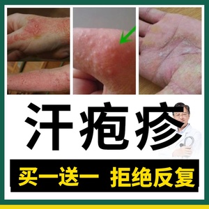 汗状疱疹专用软膏手上小水泡药膏脚手癣膏脱皮干裂汗孢疹真菌感染